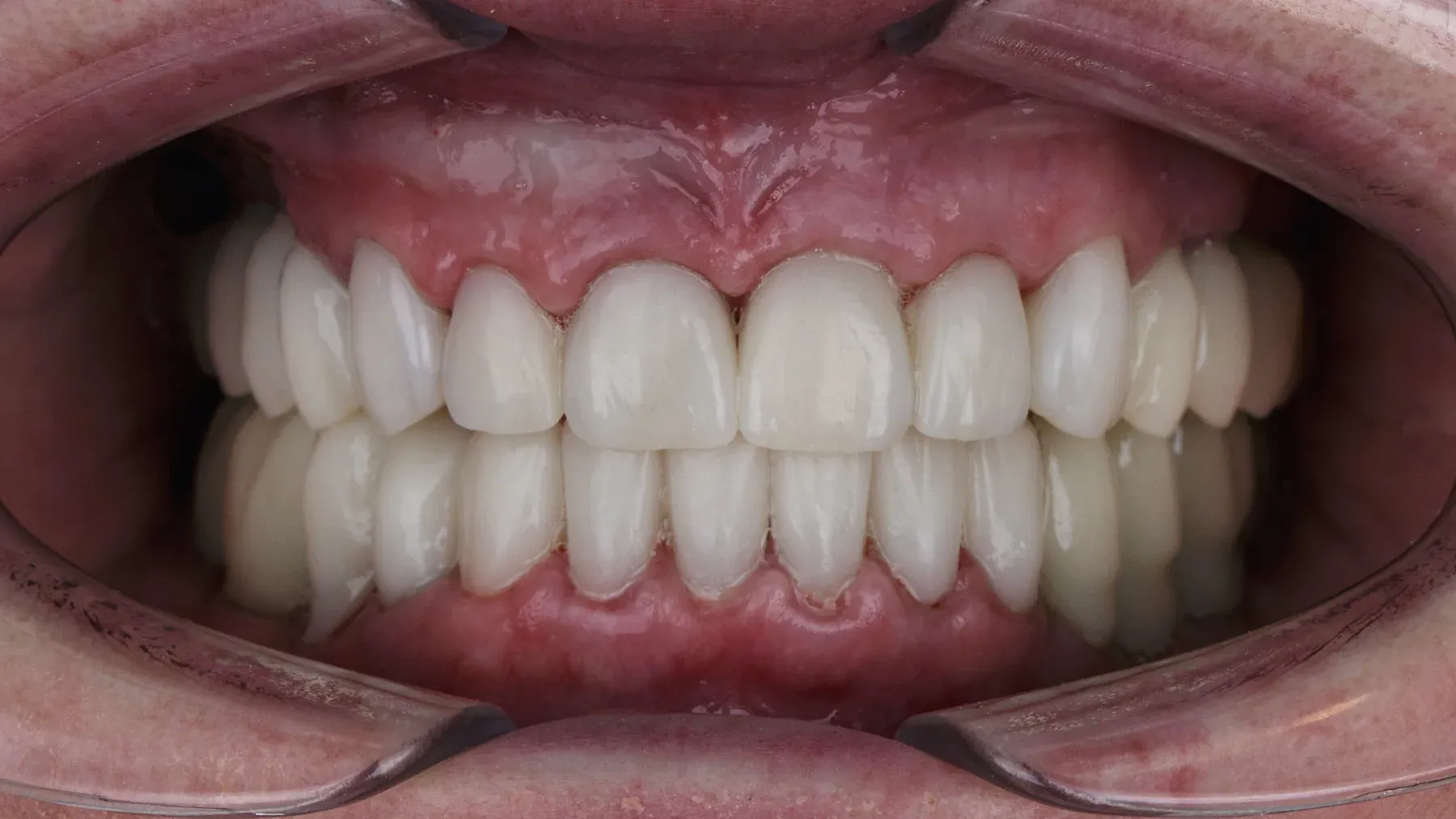 Dental result at Alta Vista Dental Care: Full-mouth restoration
