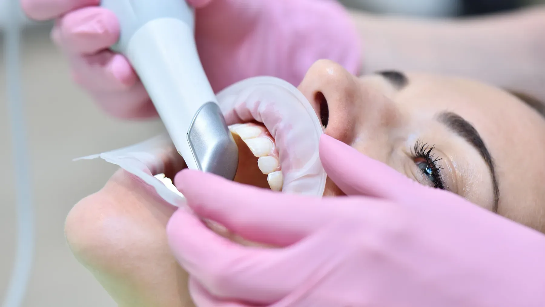 Dental result at Alta Vista Dental Care: Porcelain restorations