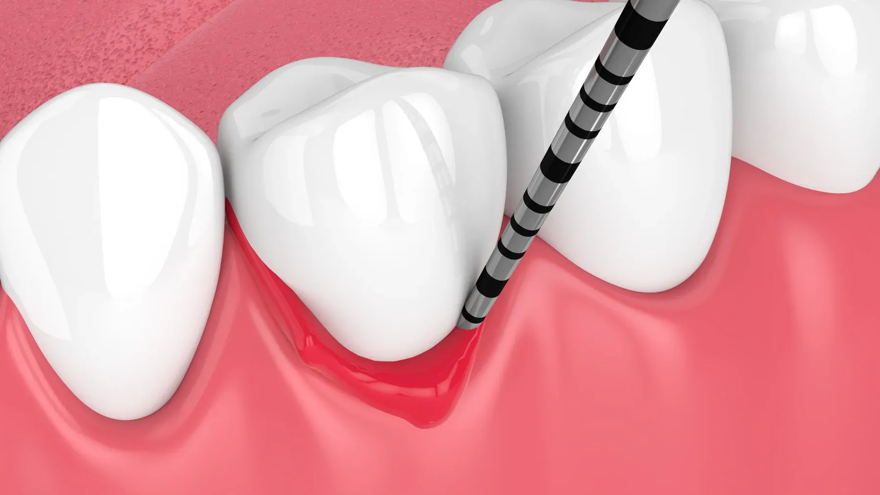 Dental result at Alta Vista Dental Care: Natural-looking crowns