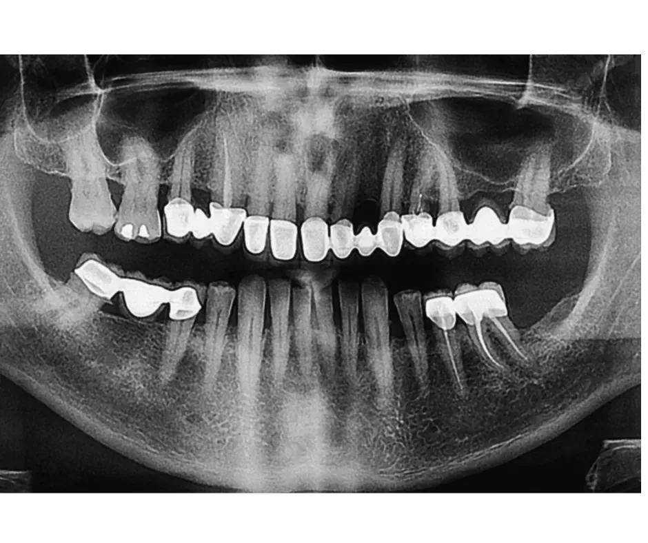 Digital X-Rays at Alta Vista Dental Care