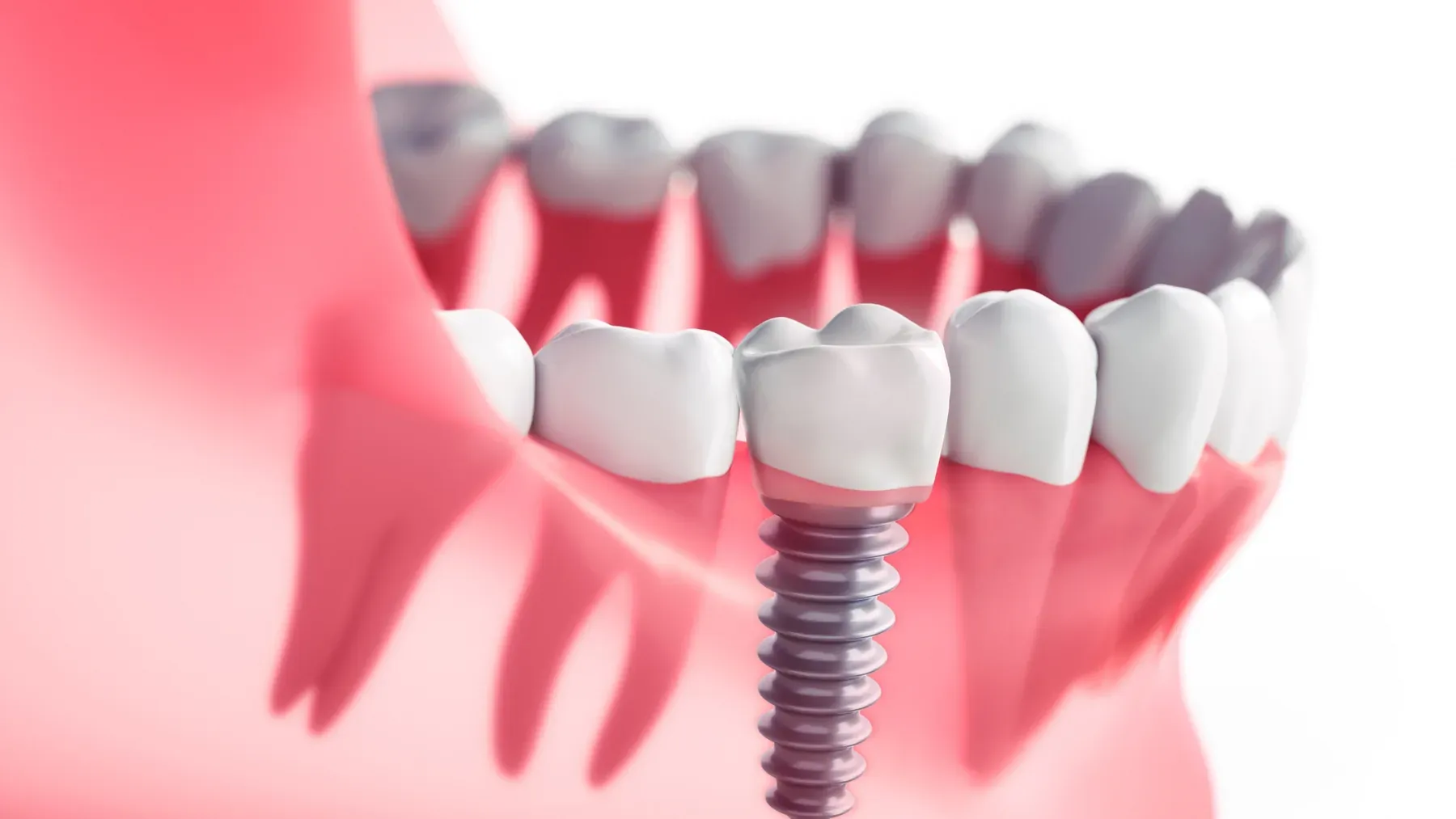 Dental Implants at Alta Vista Dental Care
