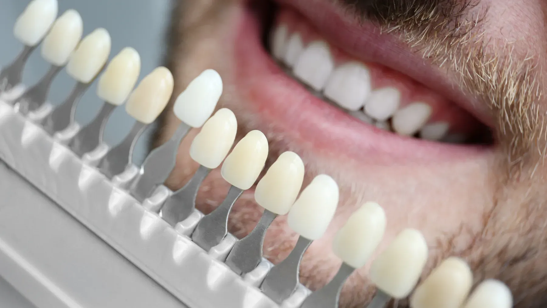 Porcelain Veneers at Alta Vista Dental Care